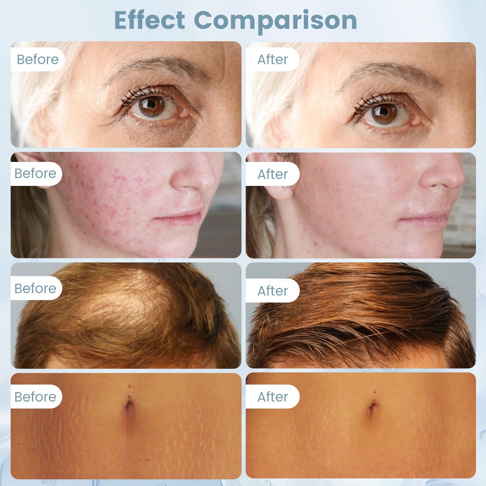 Dr. Pen Hydra Pen H3 Professional Microneedling Pen — product view 6