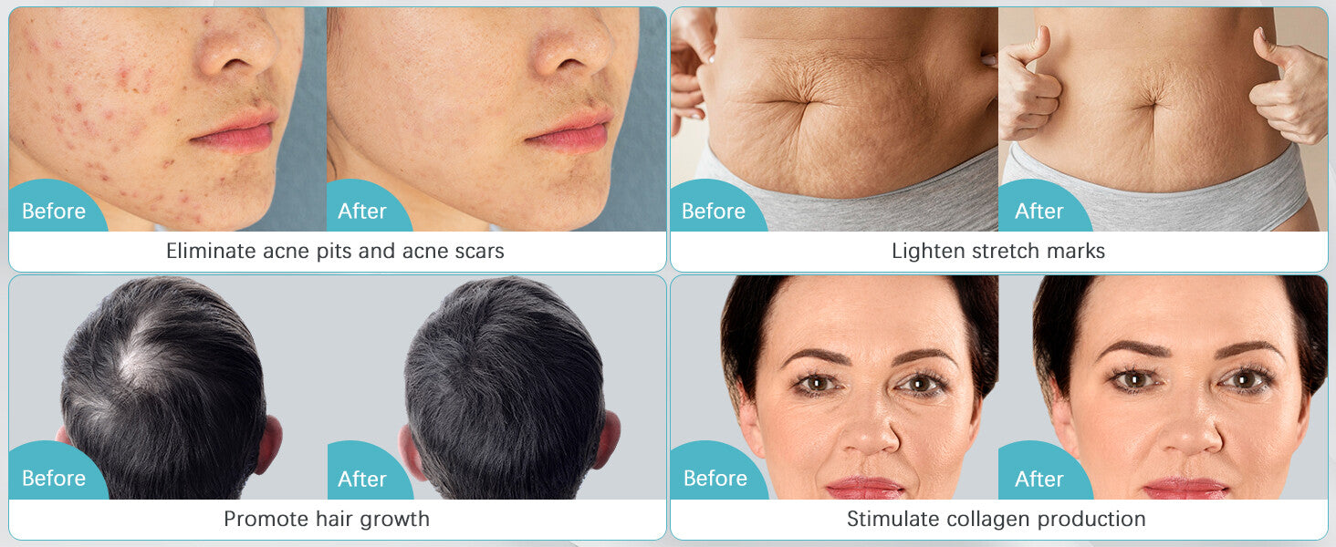 Dr. Pen M8 Microneedling Pen with 12 Cartridges — feature detail 10