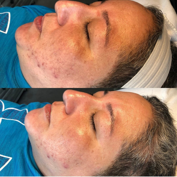 Dr. Pen M8 Microneedling Pen with 12 Cartridges — feature detail 14