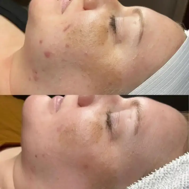 Dr. Pen M8 Microneedling Pen with 12 Cartridges — feature detail 17