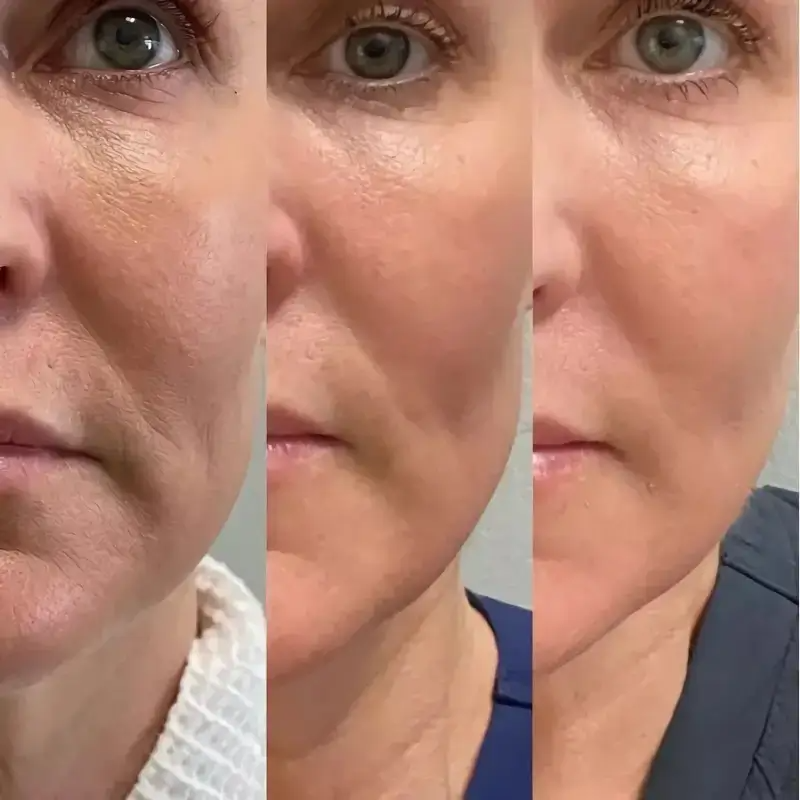 Dr. Pen M8 Microneedling Pen with 12 Cartridges — feature detail 18