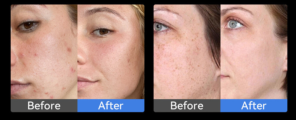 Dr. Pen Q1S Microneedling Pen with EMS and LED Therapy — feature detail 6